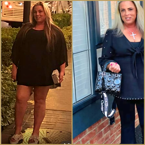 Amy’s Lipoedema Success Story